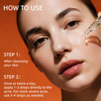 HKY Blemish Blitz Emergency Acne Serum - Fades Redness in 90 Minutes - OTC Salicylic Acid (BHA) Treatment