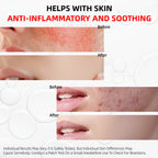 HKY Blemish Blitz Emergency Acne Serum - Fades Redness in 90 Minutes - OTC Salicylic Acid (BHA) Treatment