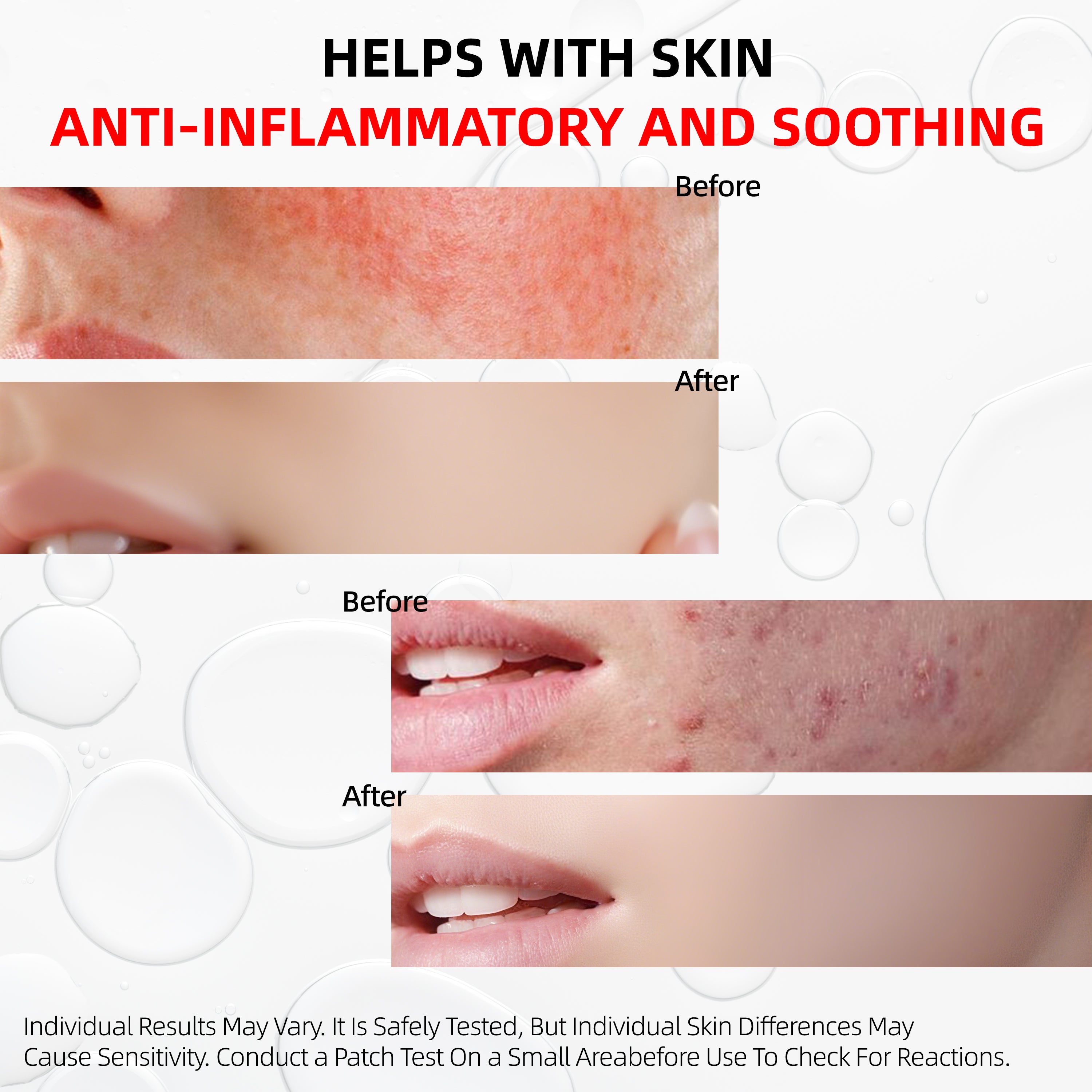 HKY Blemish Blitz Emergency Acne Serum Clear acne and dark spots while reducing inflammation